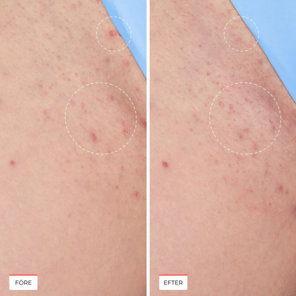 Calméa™ Ingrown Serum | Trött på smärtsam rakning och irriterande utslag? Upptäck lösningen som alla pratar om!