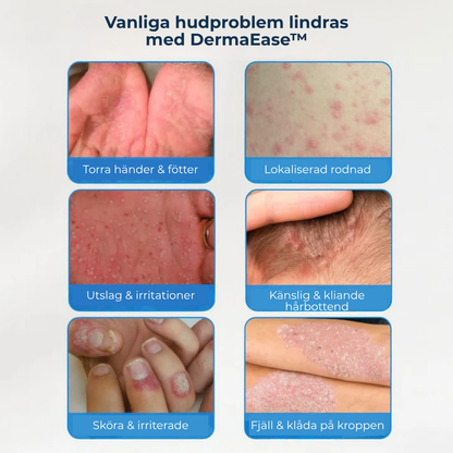 DermaEase™ | Naturlig lindring för kliande, röd och känslig hud