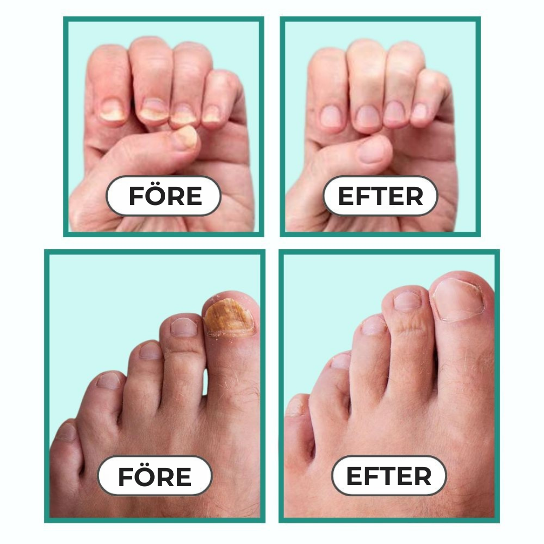 NailCure™ |Bli av med nagelsvamp för gott – se resultat på bara 3 veckor
