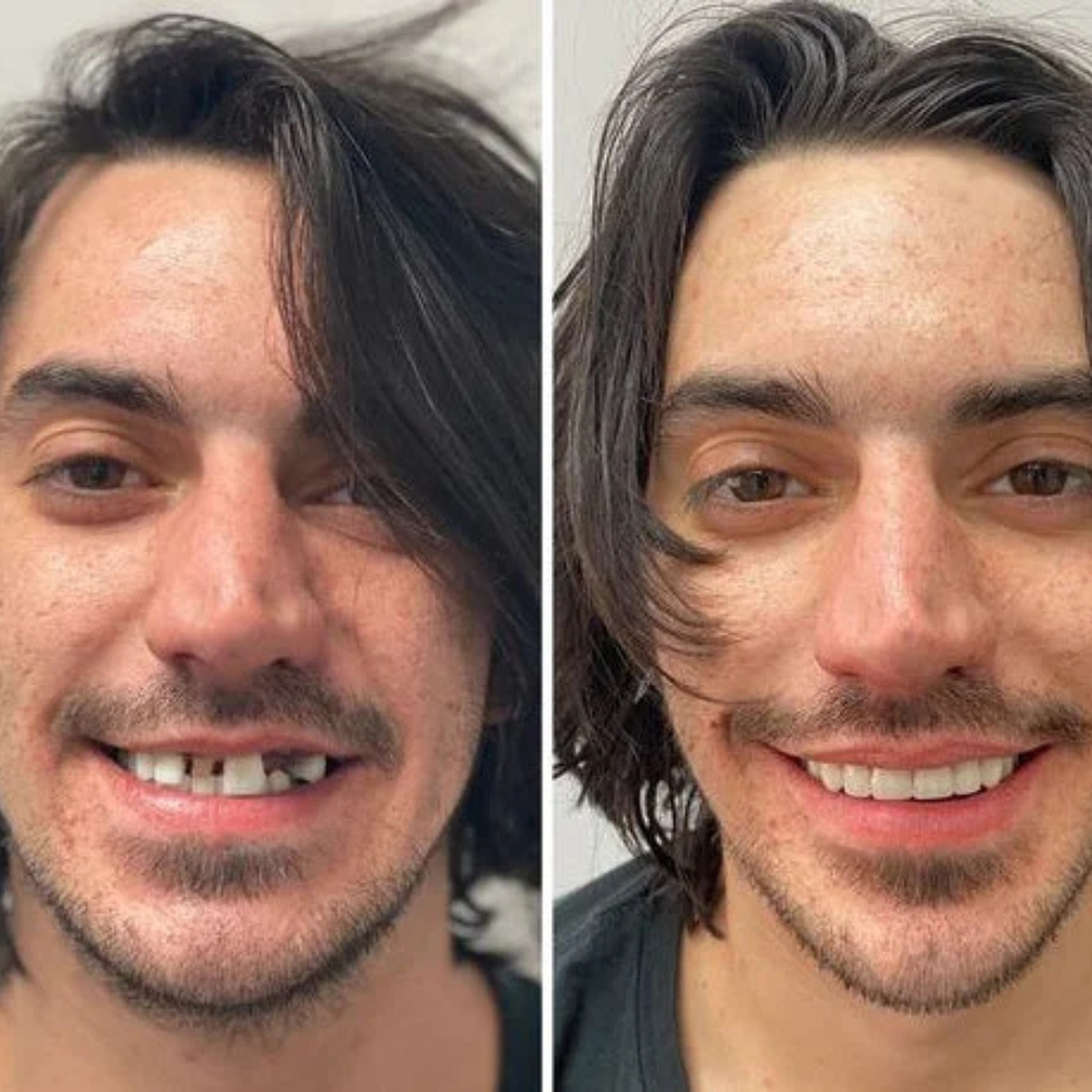 DentFix™ | Få ett starkt, självsäkert och bekymmersfritt leende hela dagen