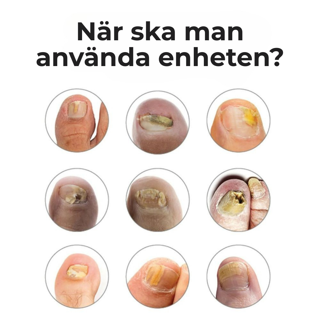 NailCure™ |Bli av med nagelsvamp för gott – se resultat på bara 3 veckor