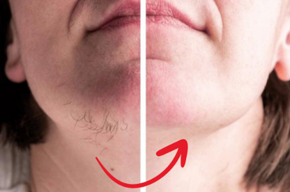 HairEase™ | Mjuk, hårfri hud utan stubb – direkt från roten