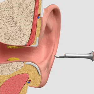 SafeHear Smart | Klara öron, bättre hörsel – SafeHear Smart för säker och exakt rengöring!